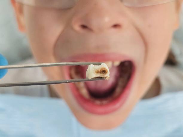 Best Emergency Broken Tooth Repair in Dripping Springs, TX